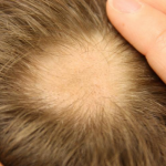 Razones por las que se puede sufrir alopecia